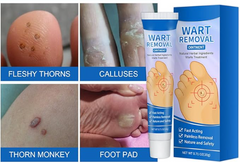 Removedor de Verrugas - Wart Removal